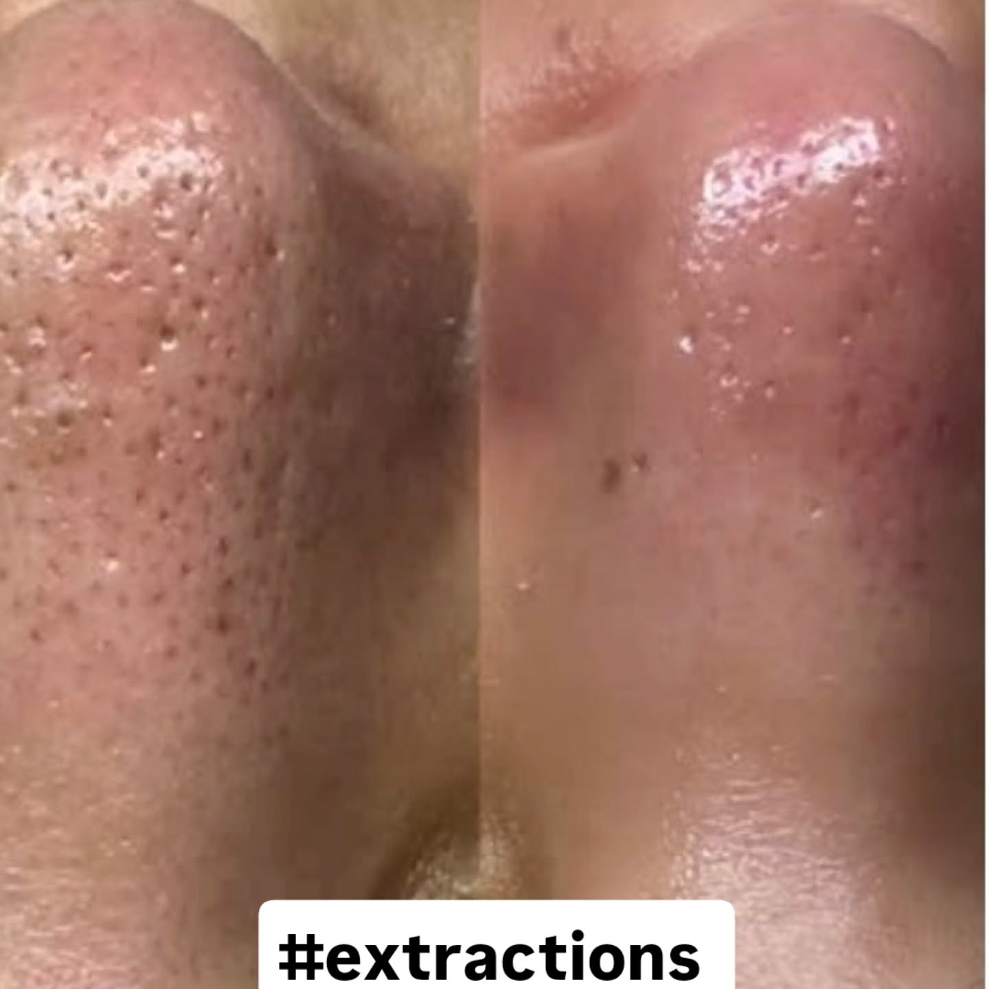 Skin texture closeup extraction treatment